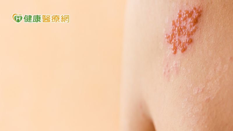 夏天如火狂燒快斬皮蛇!中醫外敷止神經痛、增強免疫力就對了