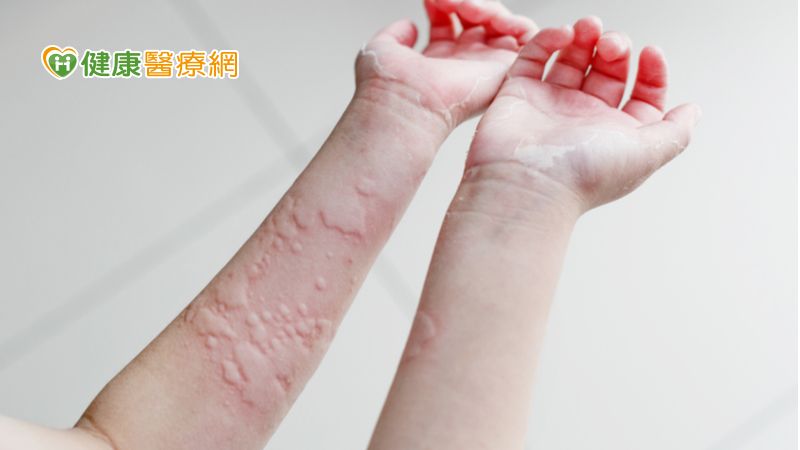 慢性蕁麻疹治不好 反覆發作可考慮生物製劑