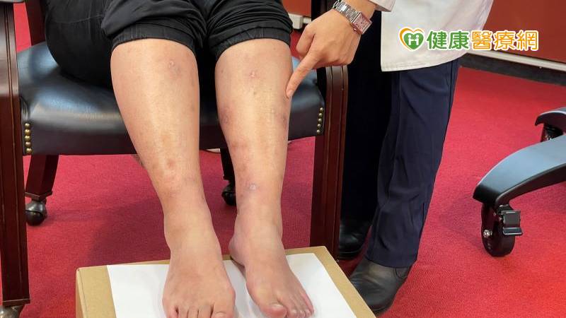 年輕女性不明腎衰竭 當心「高安氏動脈炎」惹禍